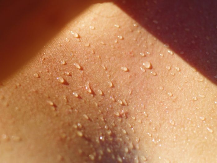 猛暑で大人の汗疹（あせも）患者が急増中
