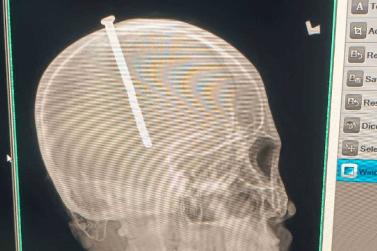 ゴミ捨て場で発見の男性、頭部から巨大な釘発見