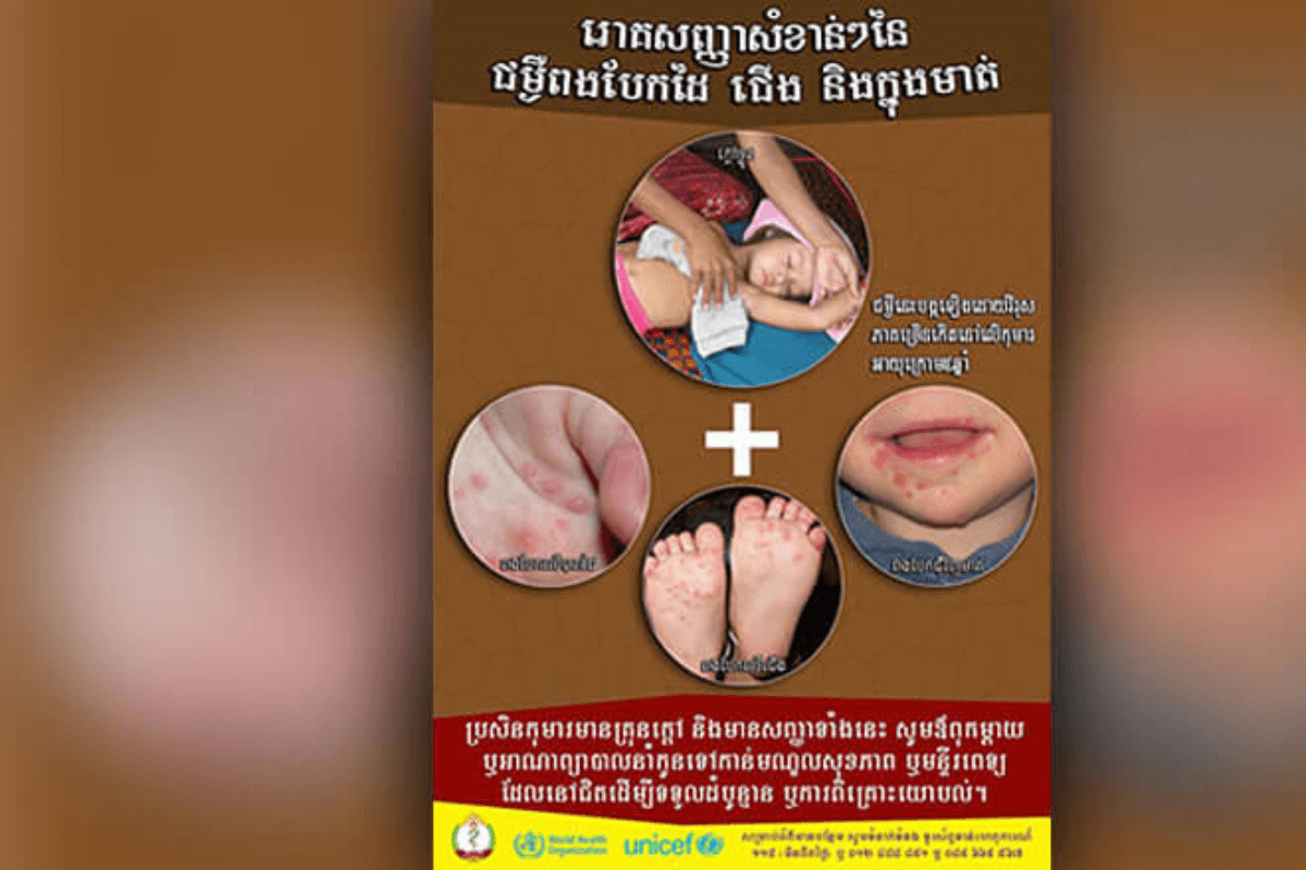 カンボジアで手足口病が拡大、保健省が注意喚起
