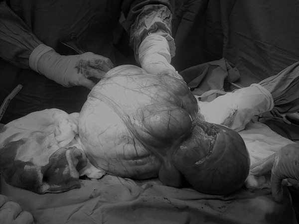 ホーチミン:女性から6.3キロの子宮腫瘍摘出
