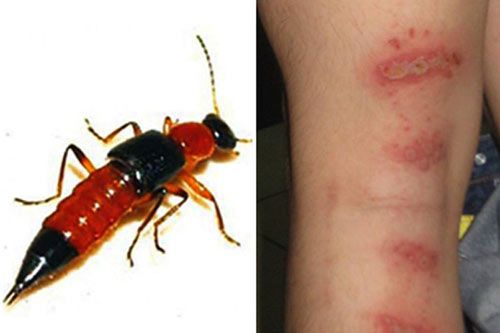 やけどのような痛みを伴う毒をもった蟻に注意してください！