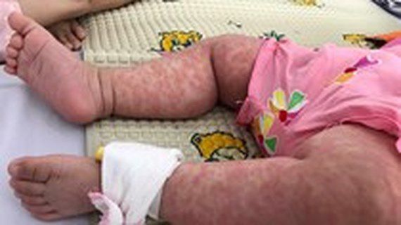 ハノイで1000人以上が麻疹に感染