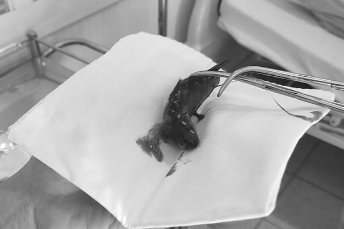 ベトナムの珍事件、魚が喉に飛び込み男性が緊急搬送