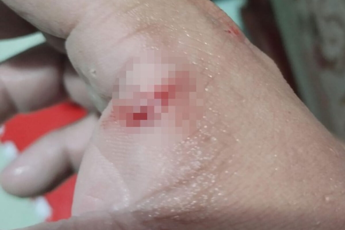 ベトナムで狂犬病の疑いの夫、妻に噛みつき出血