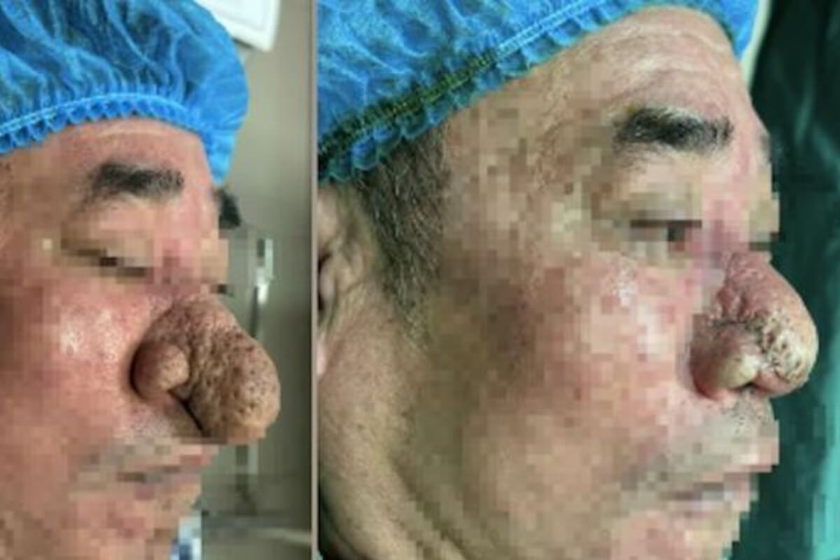 ライオンの鼻病? ベトナムで鼻が異常に肥大化した男性