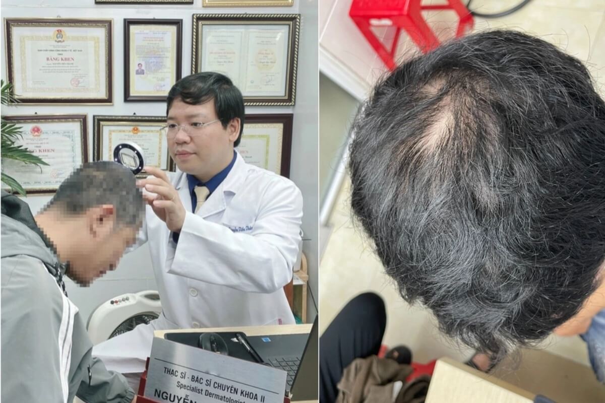 突然の脱毛に悩む男性、梅毒への感染が発覚