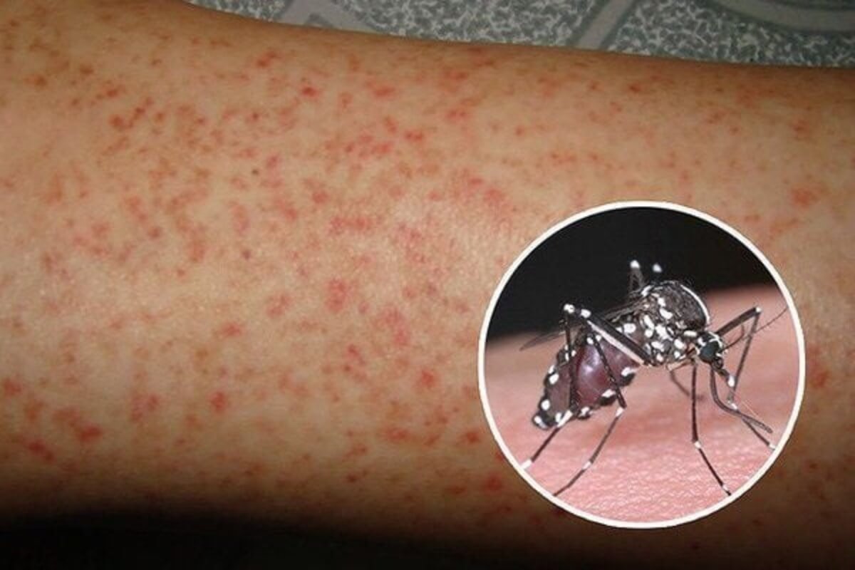 デング熱流行期の季節、家庭での3つの対策