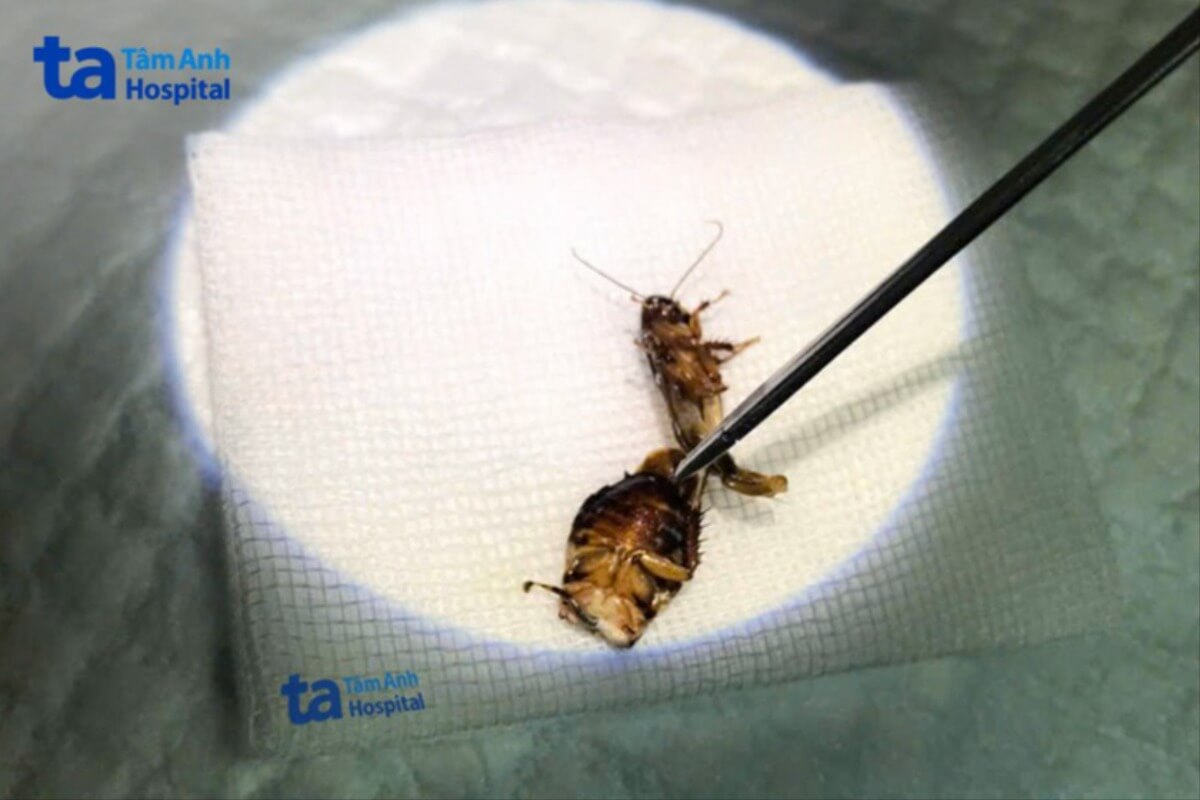 耳にゴキブリが侵入、HCMCで男性の鼓膜に充血と腫れ