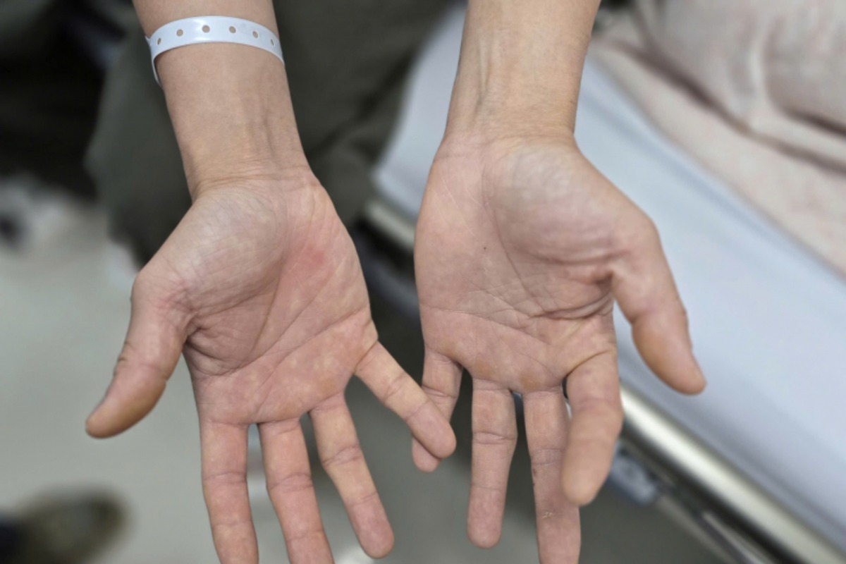 深刻化する笑気ガスの健康被害、若年夫婦が下半身不随に