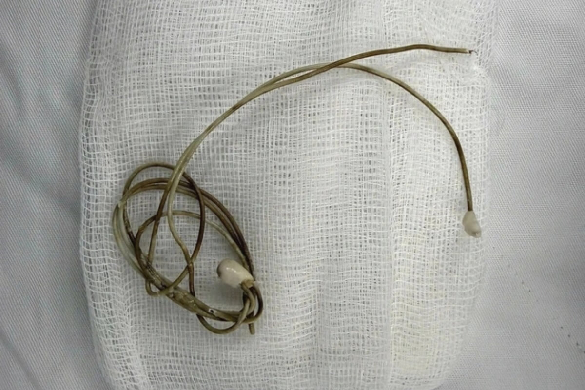 スマホケーブルを膀胱に挿入、動画模倣の学生が緊急手術