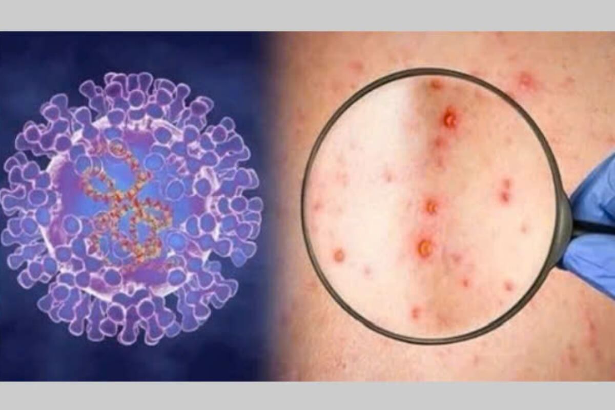 今年初のサル痘感染を確認、患者は回復傾向も当局は警戒強化