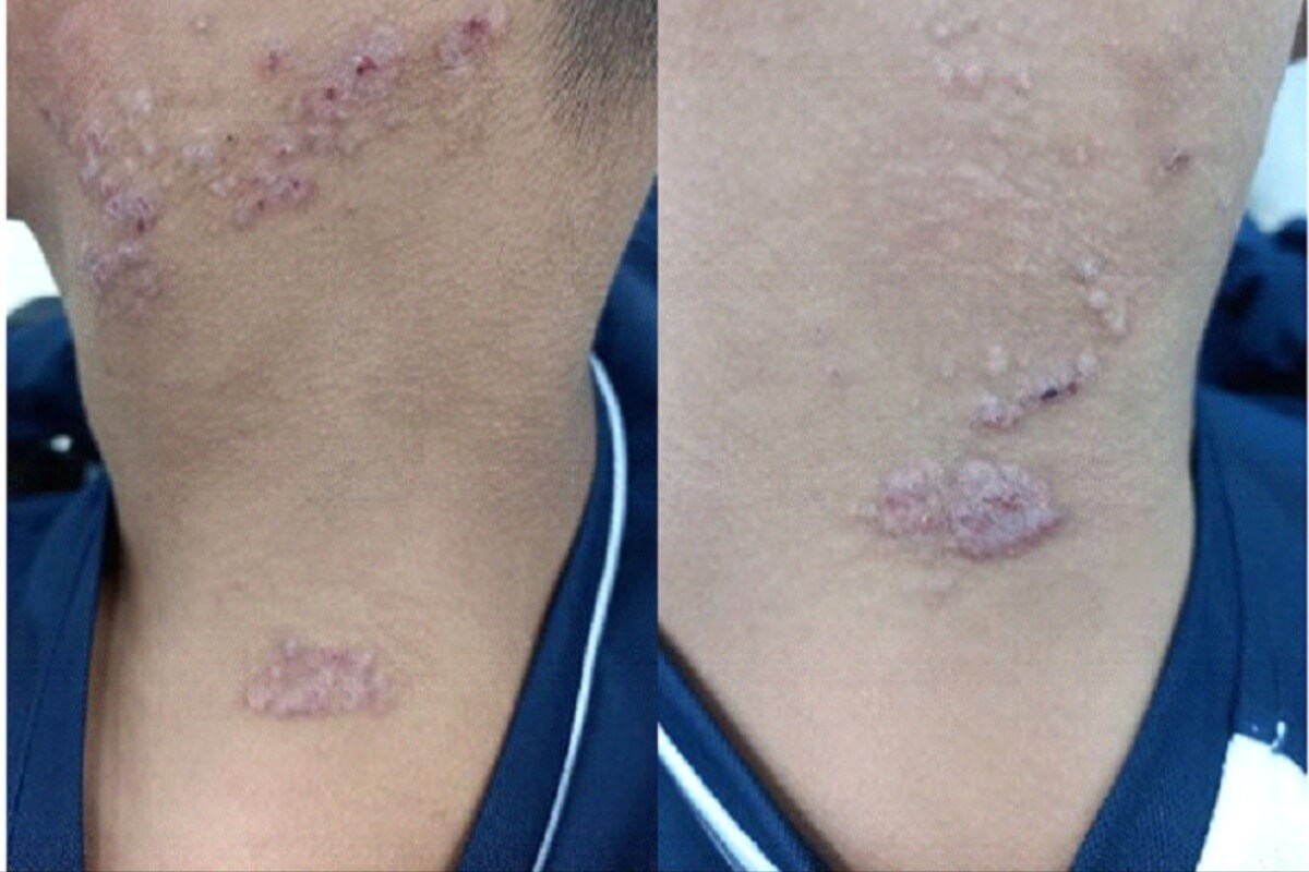 その痒みの原因は寄生虫かも、ベトナムでの食事などに注意