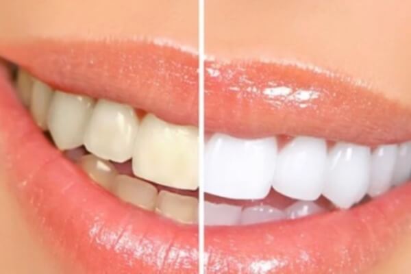 日本人歯科医師常駐のCam Tu Dental｜1回の治療でも効果抜群！ホワイトニングのご紹介